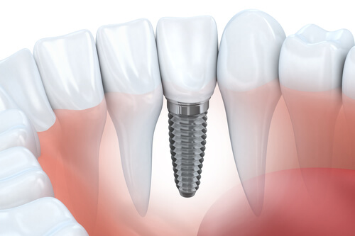 What to know about Implants